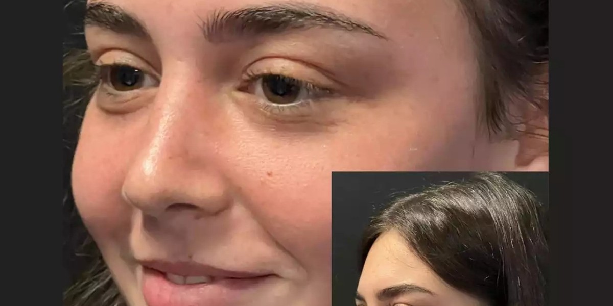 Nose Surgery in Dubai for Cosmetic and Medical Needs