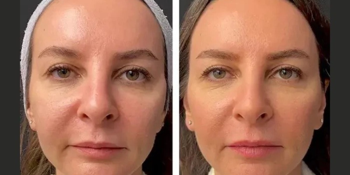 Mesotherapy Before and After: Remarkable Results from Dubai’s Top Doctors