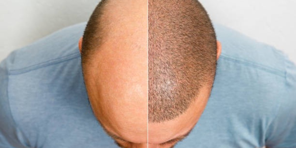 زراعة الشعر المُحسّنة بيولوجيًا في دبي: صعود دمج البلازما الغنية بالصفائح الدموية (PRP) والخلايا الجذعية