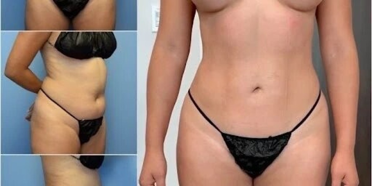 Choose the Best Body Contouring Surgeons in Dubai for Top Results