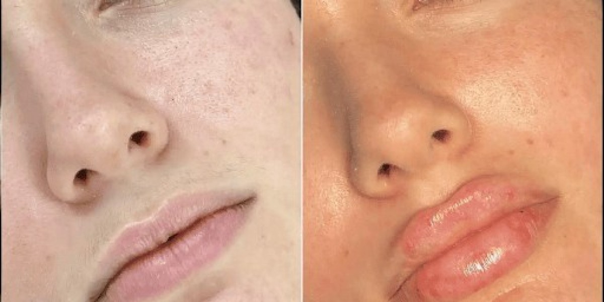 Why Fillers Treatment in Dubai Is Becoming a Beauty Essential