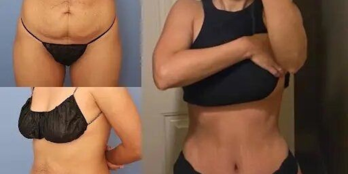What Makes the Best Tummy Tuck Surgeons in Dubai Experts?