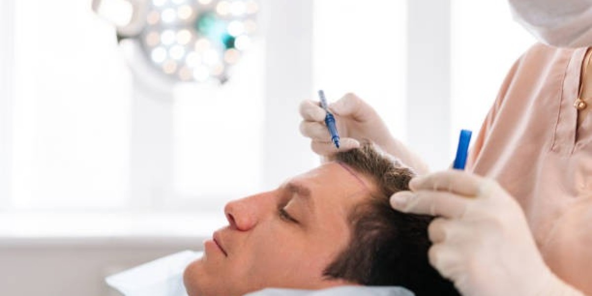 NeoGraft, FUE, and DHI in Riyadh: Which Hair Transplant Technology Reigns Supreme?