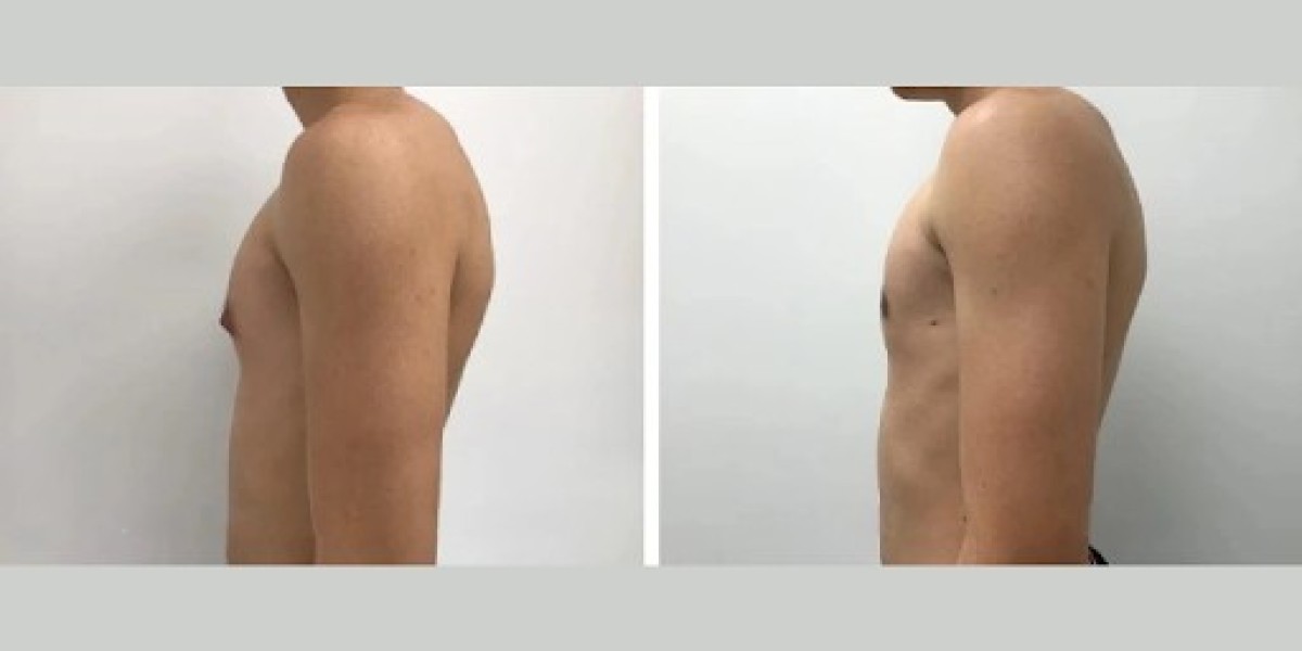 Gynecomastia Surgery: How to Choose the Best Surgeon in Dubai