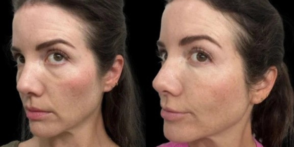 Best Doctors in Dubai Reveal Causes Behind Dark Circles and How to Treat Them