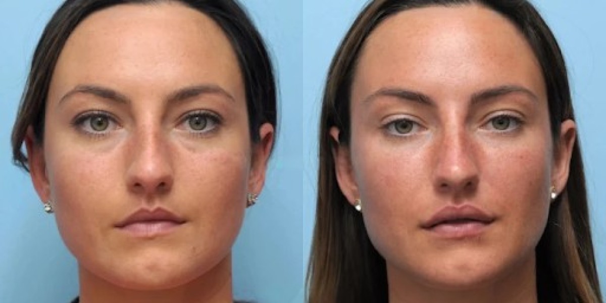 Highly Rated and Best Doctors in Dubai for Thread Lift