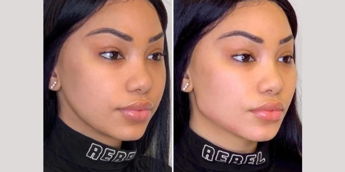 Thread Lift for Skin Tightening: What the Best Plastic Surgeon in Dubai Says